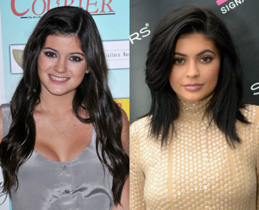 11 celeb, akire szinte rá sem lehet ismerni plasztikai műtétei után - DIVAT&STÍLUS - Celebrity - celebek, műté, plasztikai műtét, plasztikai sebészet, sztárok, 