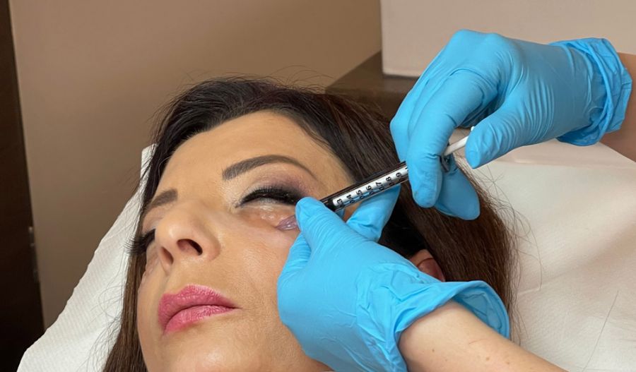 A FillMed BioNutriLift kezelés - SZÉPSÉG - Bőrápolás - arckezelés, bőrápolás, bőrápolási rutin, dr poroszkai, poroszkai mária, 