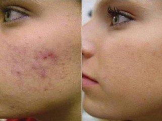 Szabadulj meg a bőrhibáktól! - Bőrápolás -  - Fabian Clinic, karikás szem, lézeres kezelés, mom park, rosacea, szépség, visszér, 