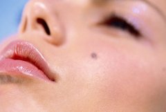 Gyanús anyajegyek! -  -  - anyajegy, 