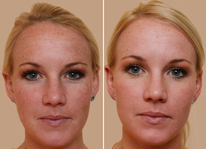 4 indok a kémiai hámlasztás mellett - SZÉPSÉG - Bőrápolás - bőrápolás, szépség, 