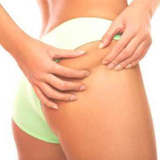 5 kezelés a narancsbőr ellen - SZÉPSÉG - Bőrápolás - bőrápolás, cellulit, narancsbőr, szépség, 