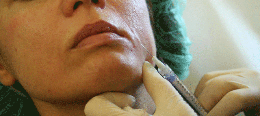 Nem mind arany, ami fénylik, avagy nem mind botox, ami hyaluronsav! - SZÉPSÉG - Bőrápolás - arcápolás, botox, hyaluronsav, szépségápolás, 